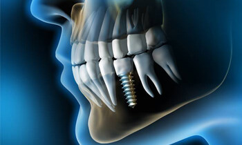 X-ray of a dental implant