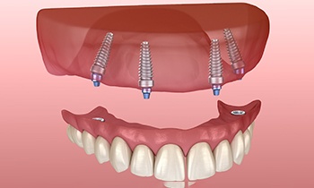All-on-4 upper denture