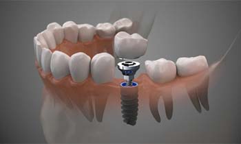 single dental implant with crown