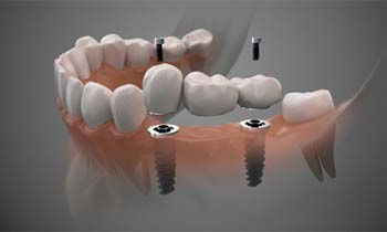 two dental implants holding a bridge in place