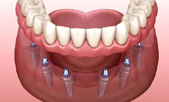 six dental implants holding a full denture