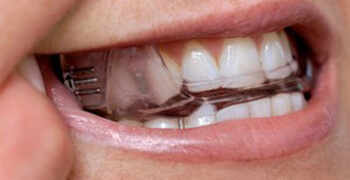 oral appliance in mouth
